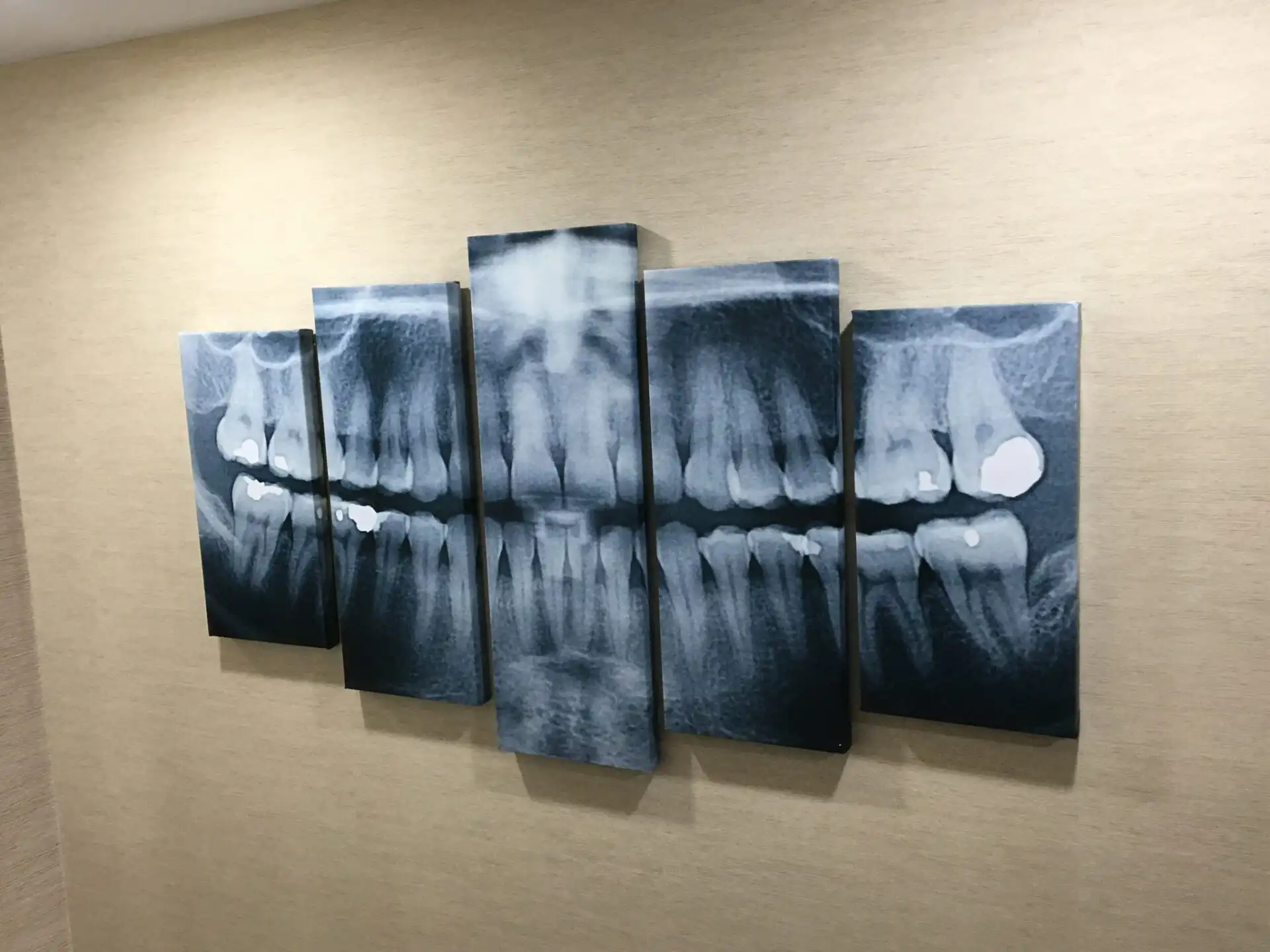 Five gallery-wrapped canvases displaying dental X-ray images, arranged side by side on a wall.