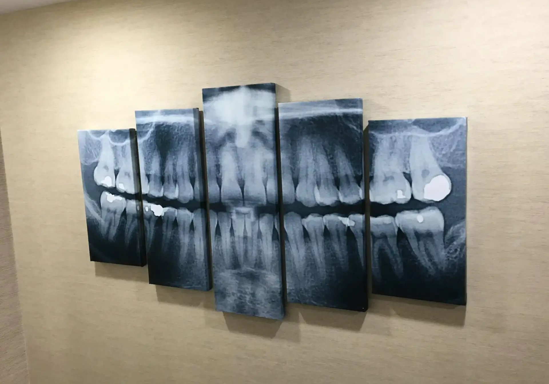 Five gallery-wrapped canvases displaying dental X-ray images, arranged side by side on a wall.